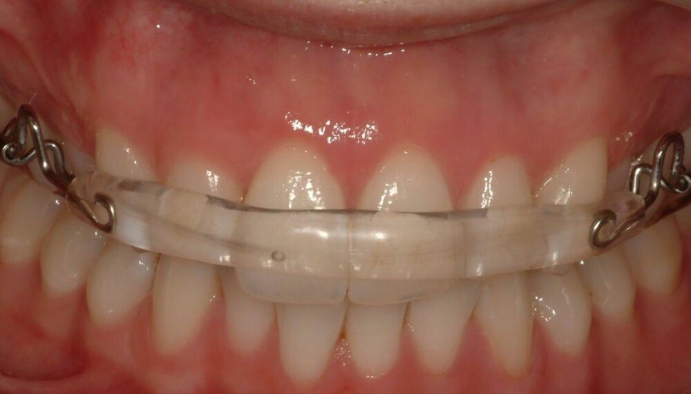 ALTERNATIV TIL TANNREGULERING: Denne platen kan erstatte vanlig tannregulering for en del voksne.