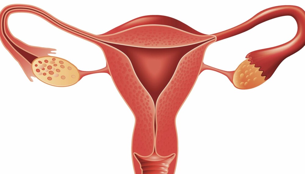 BAKOVERVENDT LIVMOR: Å ha bakovervendt eller forovervendt livmor er litt som å være høyre- eller venstrehendt, forklarer gynekolog Helena Enger. BAKOVERVENDT LIVMOR: Å ha bakovervendt eller forovervendt livmor er litt som å være høyre- eller venstrehendt, forklarer gynekolog Helena Enger.