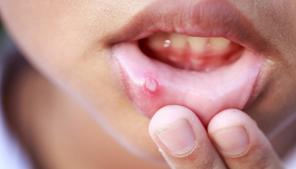 MUNNSÅR HOS BARN: Denne typen munnsår kalles after, munnskåld eller aftøse sår, og er langt mindre alvorlig enn den andre typen munnsår som ofte rammer barn; forkjølelsessår. Foto: Gettyimages.com.