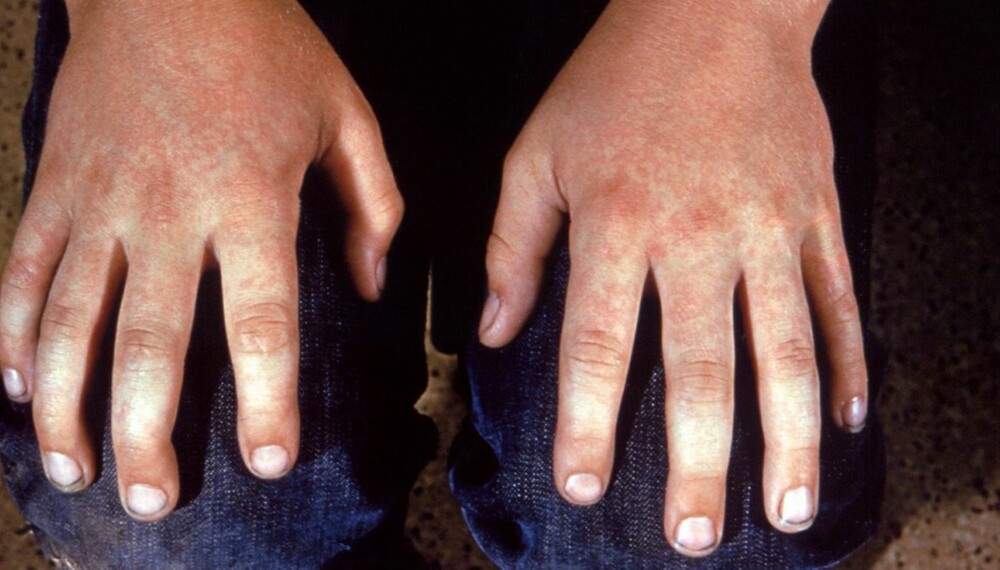 DEN FEMTE BARNESYKDOM: Også store barn kan få den femte barnesykdom. På hendene til denne ungdommen vises det røde, marmorerte utslettet som er typisk for denne sykdommen.