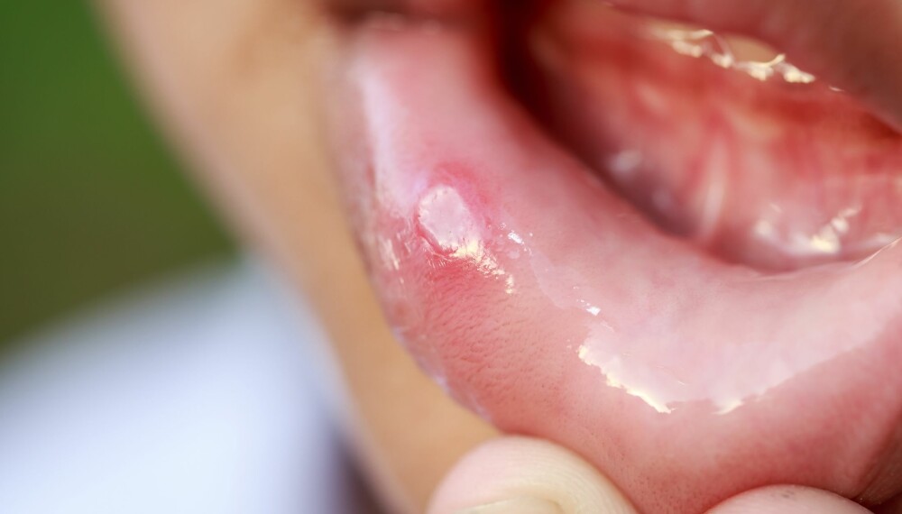BLEMMER: Det kan være mange ulike årsaker til at barnet ditt har fått blemmer eller sår i munnen, men som regel er det ikke farlig, beroliger fastlege Petter Brelin. Foto: Colourbox.