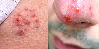 BLEMMER: Herpes gir væskefylte blemmer og sår på hud eller kjønnsorganer.