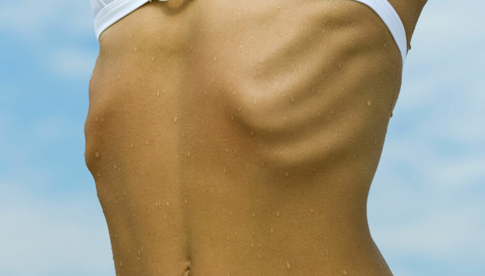 FOR TYNN? En kvinnekropp som viser ribbenskassen når armene løftes over hodet, er ganske normalt og en del av timeglassformen  kvinner har. I dag er det mange som  mener at man er undervektig når man i realiteten bare er normalt slank.