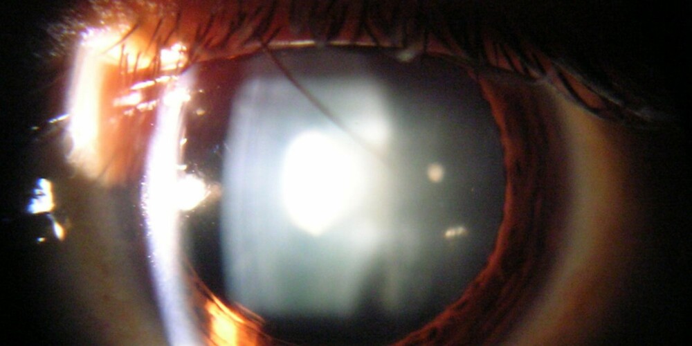 GRÅ STÆR: - Utsetter man øynene for UV-stråling over lang tid, vil man være eksponert for å utvikle grå stær (Katarakt) senere i livet, forteller øyelege Willy Pettersen.
