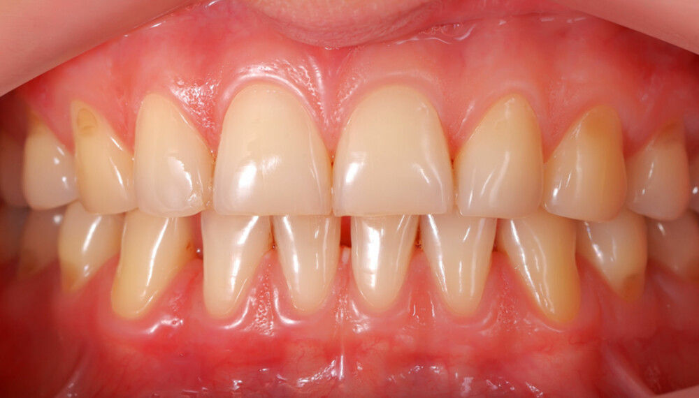 PROBLEM: Dersom du allerede har ising i tennene, bør du gjøre noe med problemet. Foto: COLOURBOX