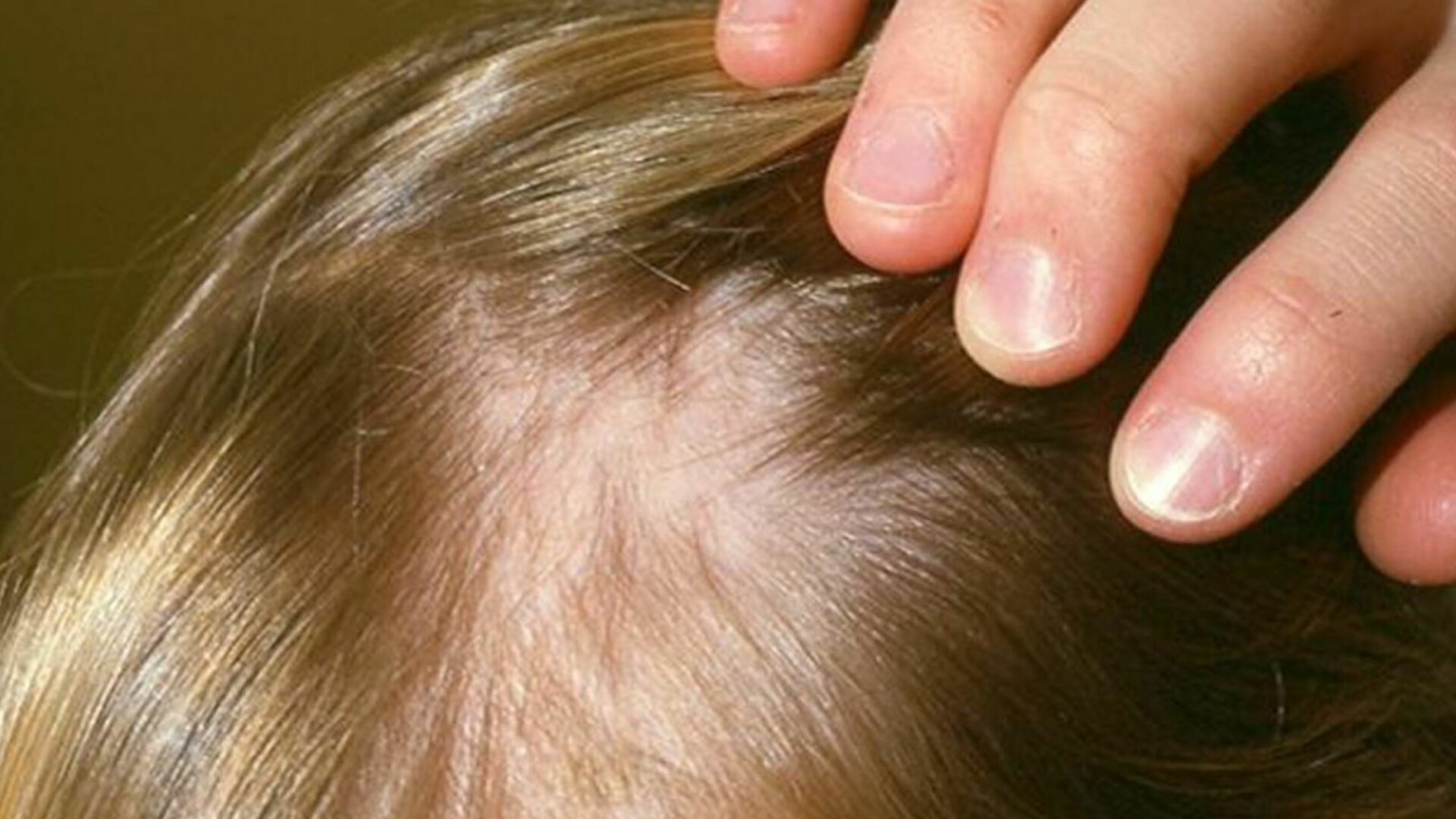 Причины выпадения волос у подростка. Гнёздная (очаговая алопеция). Очаговая алопеция (alopecia Areata). Гнёздная очаговая алопеция у детей. Залысина на голове у ребенка.