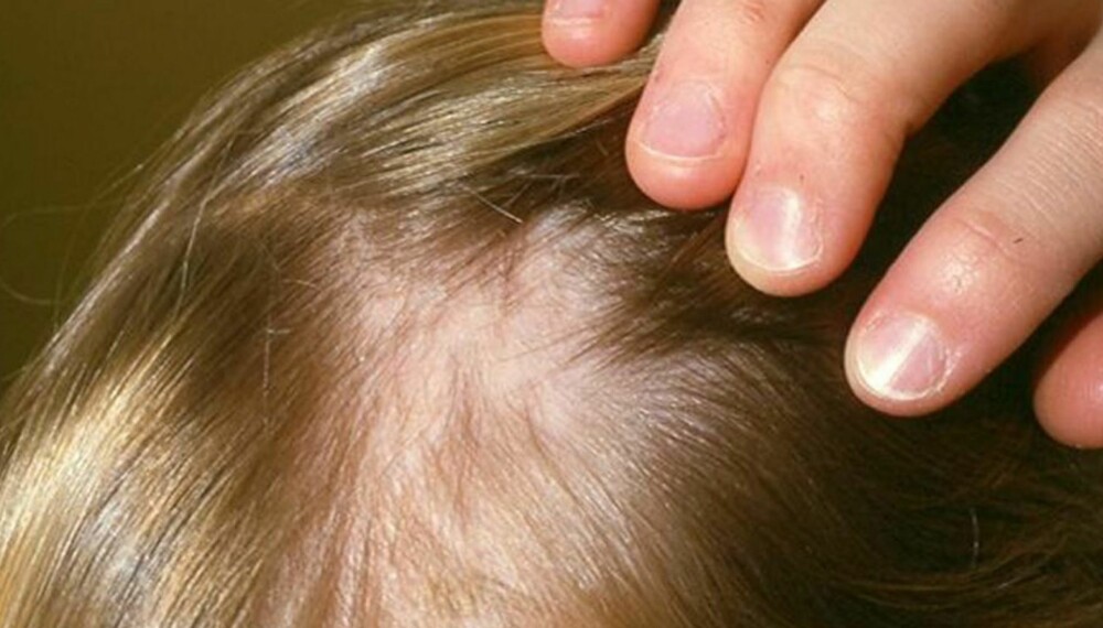 FLEKKVIS HÅRTAP: Såkalt alopecia areata, eller flekkvis håravfall, er en hudsykdom der en person helt plutselig får hårløse hudflekker. Årsaken er ikke kjent, men mye tyder på at det er en autoimmun forstyrrelse.
