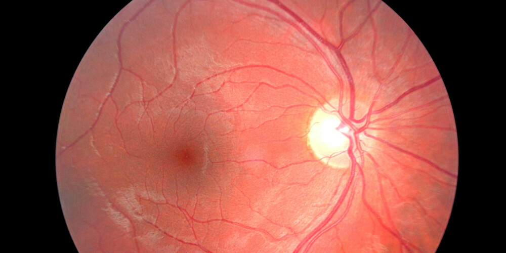 ØYET: Anatomien til et øye består det av et forkammer og ett bakkammer, som skilles av iris. Bakkammeret er fylt av en stor væskeball, kalt corpus legemet. Den minner om en gele, og fyller hele hulrommet i øyet.