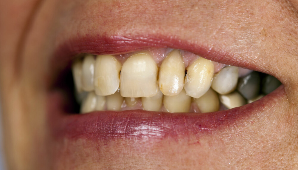 TANNHELSE: Gule tenner, skarp tannpine, blødende tannkjøtt; dette kan det bety.
