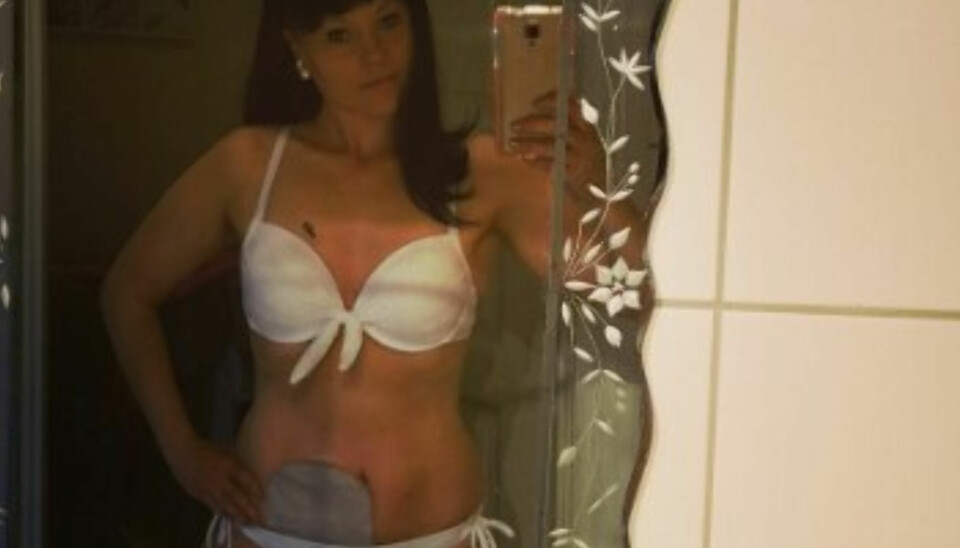 - Jeg er lita, har brannsår og pose på magen – men jeg er bra nok. Begrepet ”sommerkropp” provoserer meg, sier Anette Kvernvik.