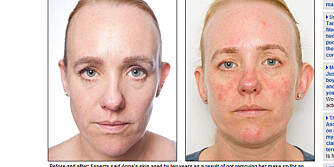 FØR OG ETTER: Eksperter sier Anna Pursgloves hud har eldes med ti år som følge av ikke å fjerne sminken på en hel måned.