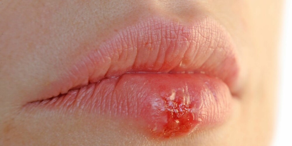 SAMME VIRUS: Herpes keratitt er forårsaket av herpes 1, samme viruset som lager munnsår. Hornhinnen får også sår. De er grenformede.