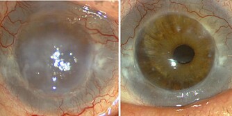 FØR OG ETTER: Nærbilde av et øye før og etter en hornhinnetransplantasjon.