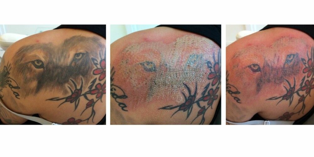 FJERNER TATOVERINGEN: Bilder som viser et område før, under og etter første behandling. FOTO: Eraze. FJERNER TATOVERINGEN: Bilder som viser et område før, under og etter første behandling. FOTO: Eraze.