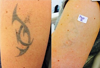 FØR OG ETTER: Utgangspunktet og resultatet etter ferdig behandling med laser. FOTO: Eraze Oslo. FØR OG ETTER: Utgangspunktet og resultatet etter ferdig behandling med laser. FOTO: Eraze Oslo.