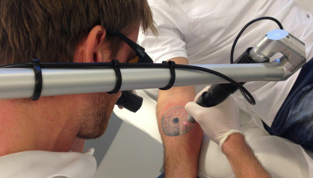 LASER: En kunde får fjernet en tatovering ved hjelp av laser. FOTO: Eraze Oslo. LASER: En kunde får fjernet en tatovering ved hjelp av laser. FOTO: Eraze Oslo.