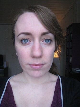 MAREN-ANNE MELVIK: Prøvde isotretinoin mot kvisene. MAREN-ANNE MELVIK: Prøvde isotretinoin mot kvisene.