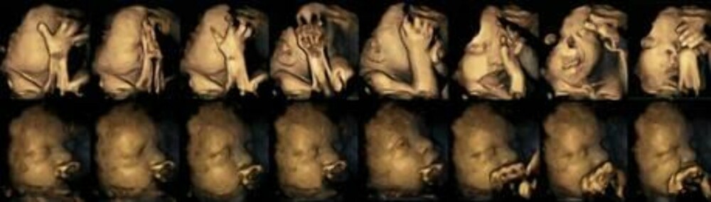For første gang har forskere kunne se effektene av røyking hos barn som fortsatt er i livmoren. De øverste ultralydbildene viser reaksjonene hos et foster som har en mor som røyker. De under viser et foster med en ikke-røykende mor.