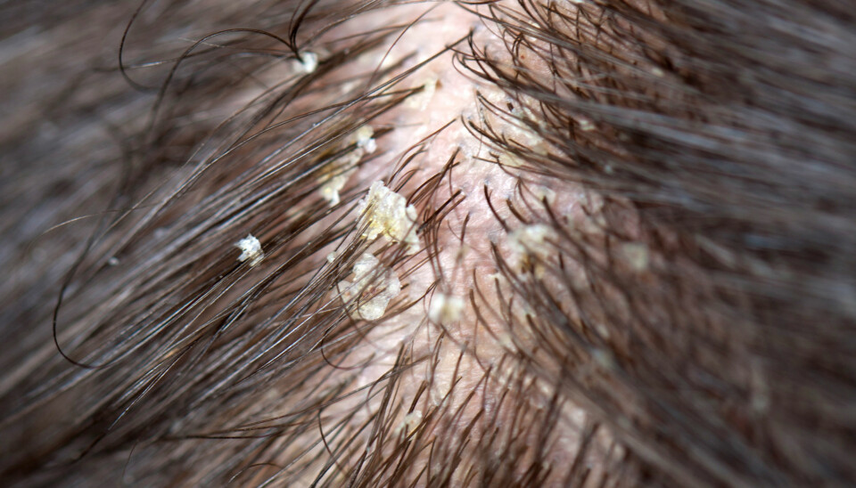 FLASS: Sliter du med fet hodebunn kan dette trigge flassdannelse. ILLUSTRASJONSFOTO: Colourbox