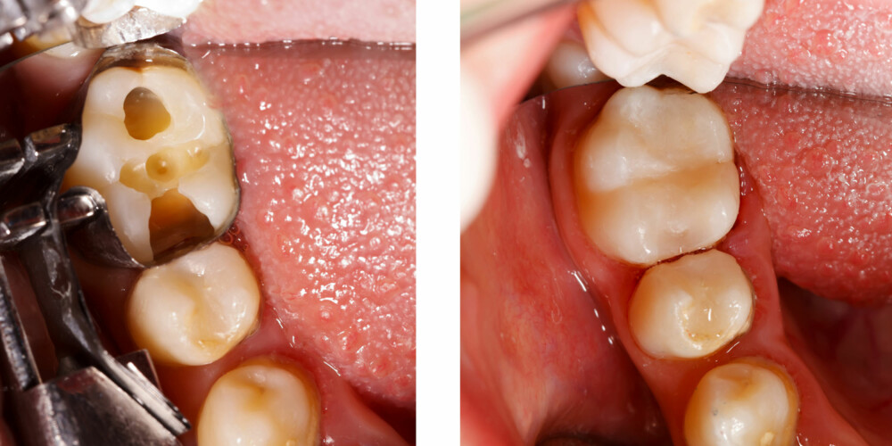 TANNLEGE-TABBER: En typisk skade etter feil behandling hos tannlege kan være at du mister en bit av tannen, det kan også være betennelser eller skader på nerver.