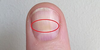 MISFARGING: Neglene kan fort bli misfargede av neglelakker - spesielt hvis man sløyfer base-coat, men det finnes triks til å fjerne de gule flekkene.