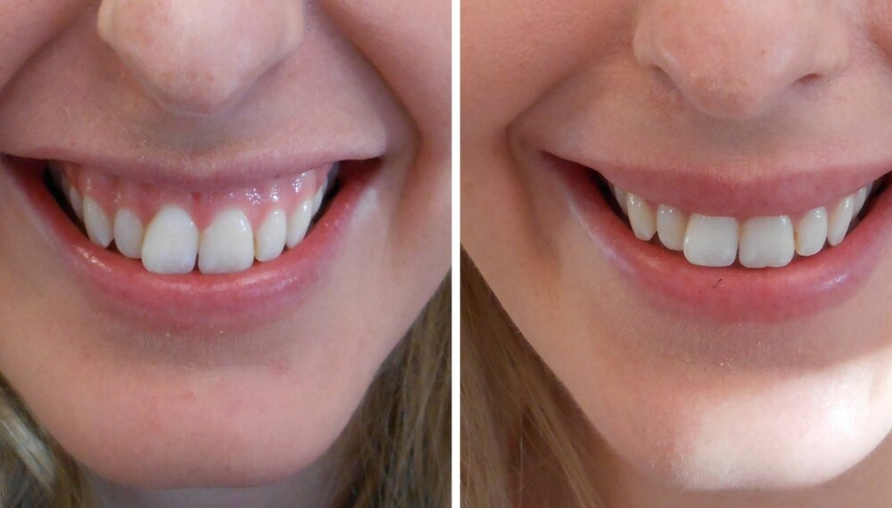GUMMYSMILE: Michelle Fayen (25) har nettopp utført et Botox-inngrep for å unngå såkalt «gummysmile», altså en betegnelse på at du trekker overleppen høyt oppover mot nesen når du smiler, slik at mye av tannkjøttet kommet til syne. Til venstre: Før injiseringen. Til høyre: Etter Botox-inngrepet.