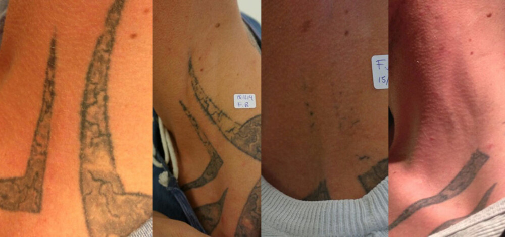 TRIBAL: Bildene viser en mann som ønsket å fjerne delen av en tribaltatovering som slynget seg oppover nakken. Slik så området ut etter fire behandlinger med laser.