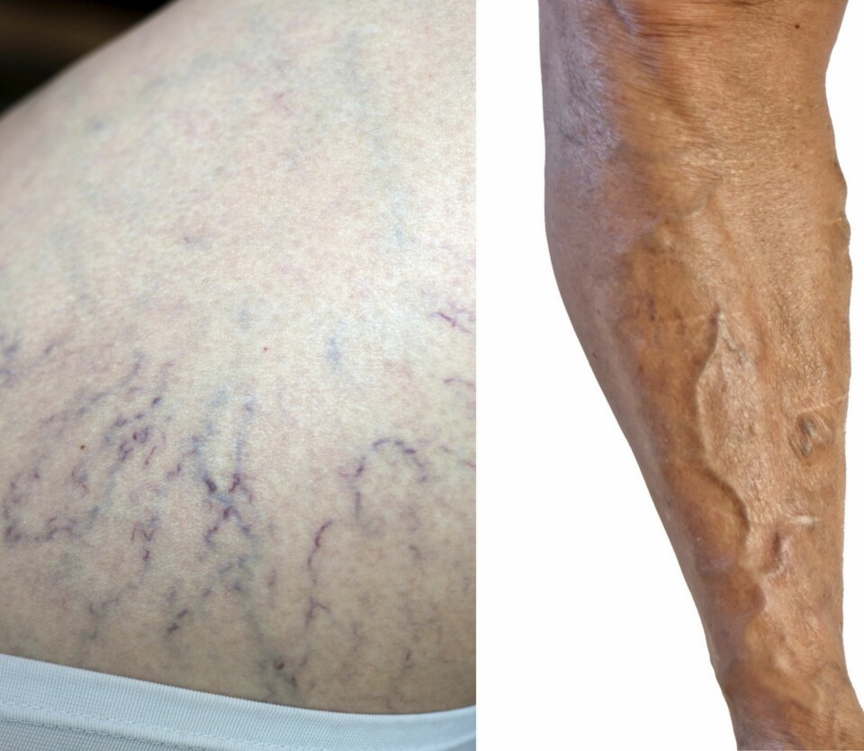 IKKE DET SAMME: - Spindelårene på det venstre bildet egner seg meget godt for Sclerosering, mens bildet til høyre viser åreknuter som ikke kan gjennomgå samme behandling, forklarer dermatologisk sykepleier ved Injeksjonsspesialisten, Stine Møsth Gikling.