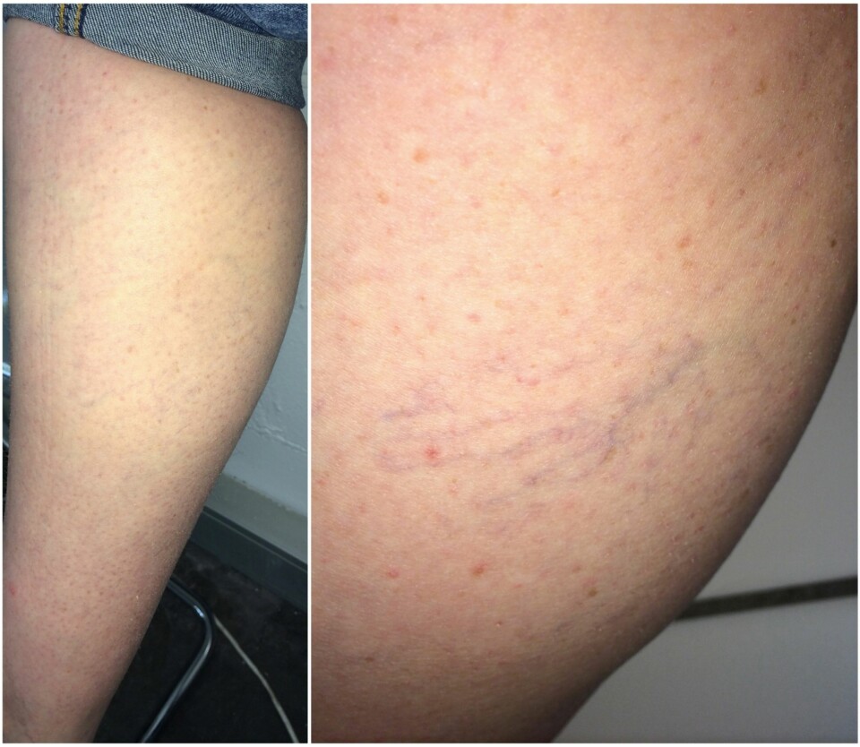 VERDT Å VENTE PÅ: Selv om det tok litt over 2 måneder var Tove strålende fornøyd med resultatet. Spindelvevåren (høyre bilde) som ble behandlet kan ikke lenger sees på benet (venstre bilde).
