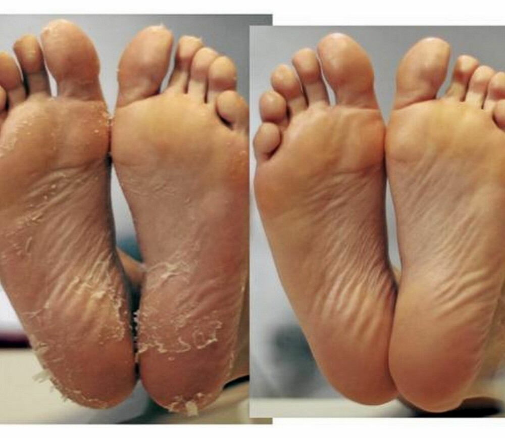 BABY FOOT: Redigerer i Kamille, Agneta Soleim McDowall, har tidligere testet produktet "Baby Foot" som sørger for at død hud faller av, og ny hud kommer til.