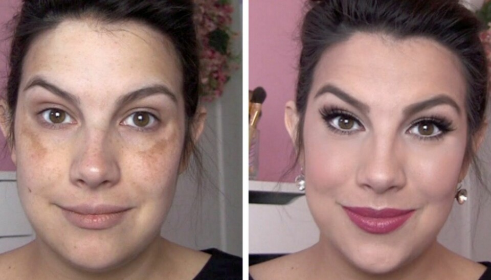 HELT DEKKET: YouTube-kanalen Beauty Broadcast drives av amerikanske Emily Noel, og videoen hennes som viser hvordan melasma og pigmentflekker kan dekkes med sminke, er blitt en stor hit.
