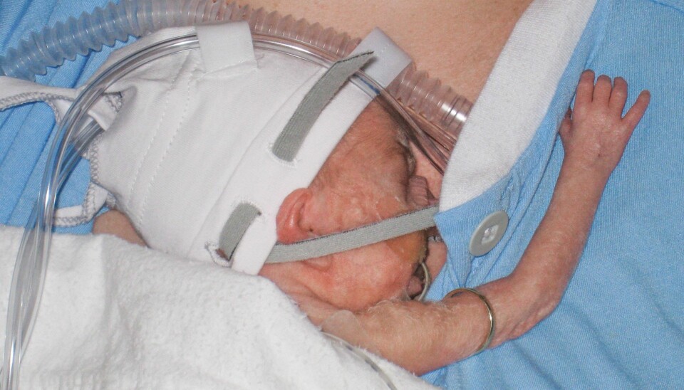 BITTE LITEN: Vårin var så tildekket av maske og ledninger at foreldrene ikke fikk se ansiktet hennes ordentlig før det var gått to måneder.