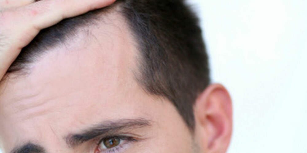 BEGYNNER TIDLIG: Mannlig hårtap kan begynne allerede i tenårene som klassiske m-viker.
