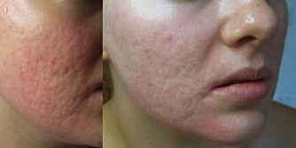 MICRONEEDLING: En populær behandling hos hudpleier er såkalt microneedling. Her er førbilde (til venstre) og etterbilde av aknearr behandling med microneedling.