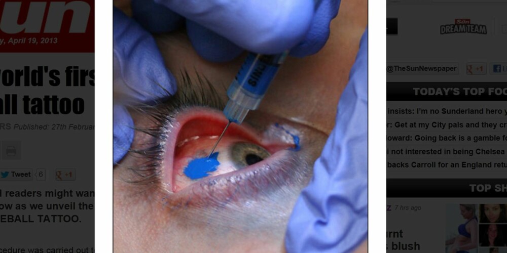 ØYETATOVERING: Blekk sprøytes direkte inn i øyet for å farge det blått. For alltid.