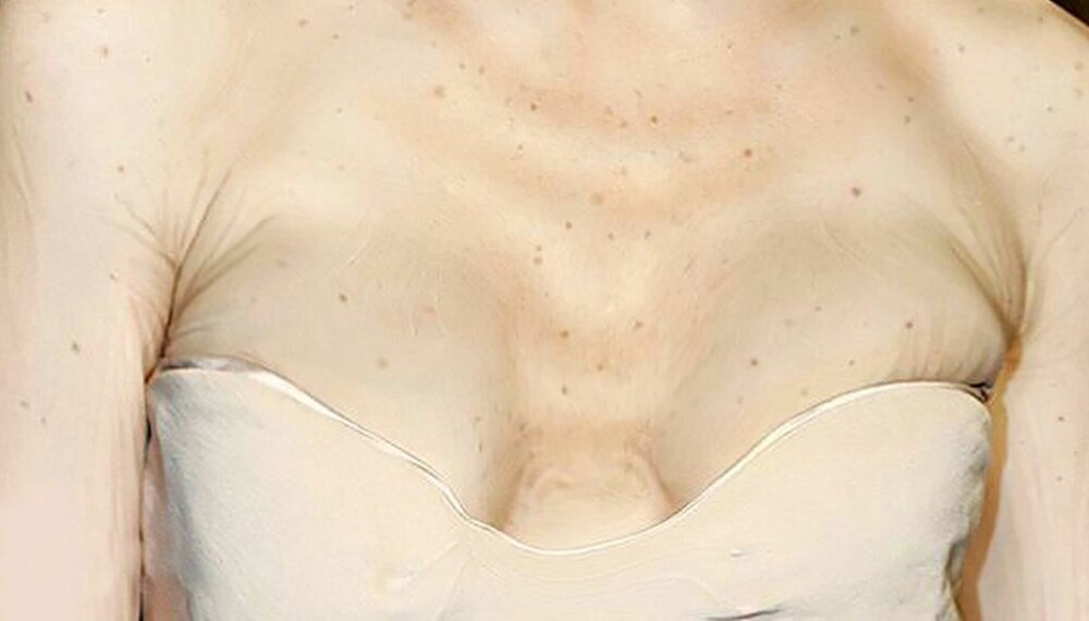 SUNNE SOLVANER? Brystet er det stedet der de fleste er mest utsatt - og glemmer å smøre seg nok. Det kan resultere i at huden din ser mange år eldre ut enn den egentlig er.