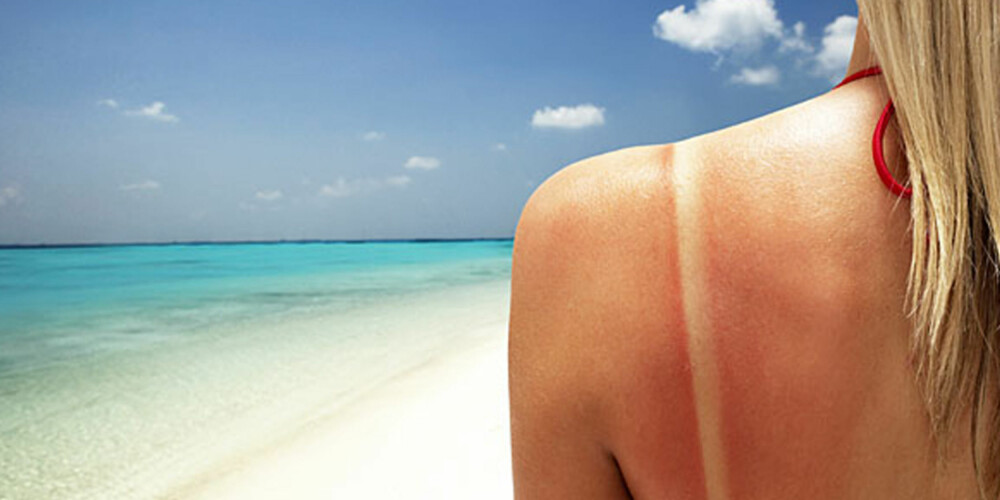 HETE STRÅLER: Når huden blir rød er det kroppens forsvarssystemer som forteller deg at nå er det på tide å komme deg ut av sola.
