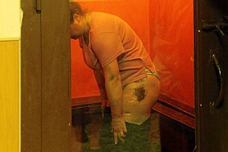 En kvinne viser fram blåmerkene sine etter et besøk på torturrommet.