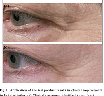 FØR OG ETTER: Bildet viser at rynkene ved øyet er blitt redusert ved bruk av antirynkekremen til No7.