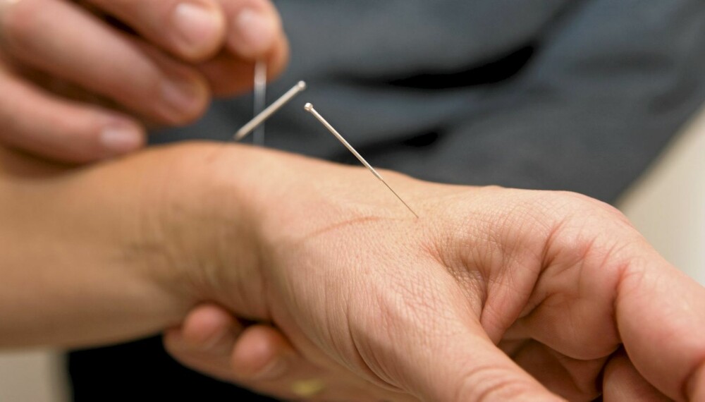 NÅLER: Akupunktur kan hjelpe mot allergiplager.
