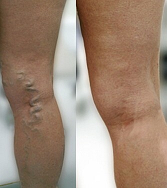 FØR OG ETTER: Tykke blodårer som slynger seg oppover bena kan enkelt fjernes, og det finnes flere metoder. Kvinnen på bildet har brukt laser.