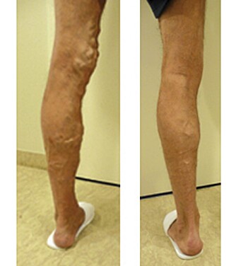 FØR OG ETTER: Førbildet av denne mannens ben viser et kraftig tilfelle av åreknuter.