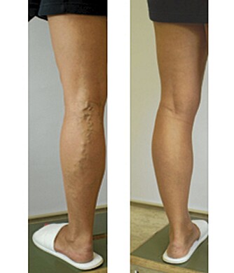 FØR OG ETTER: Bildet viser en kvinne før og etter laserbehandling av åreknuter.