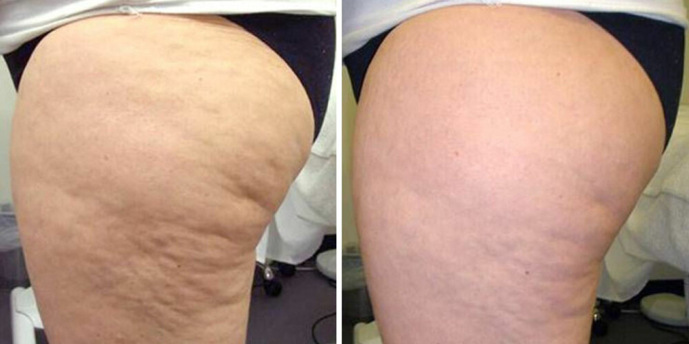 CELLULITTER: Med contour-behandlingen rydder også opp i cellulitter. Bilde før og etter behandling.
