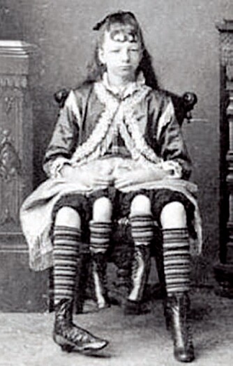 Myrtle Corbin (1868-1928) var meget populær, reiste rundt med en rekke av tidens store sirkus og tjente så mye som 450 dollar i uka. Hun ble presentert som ¿den firbeinte jenta¿, men det ene beinparet hørte til en ikke utviklet tvilling. Myrtle giftet seg med en lege og fikk fem barn. Ifølge legenden hadde hun to forplantningssystemer og fødte barn fra begge.