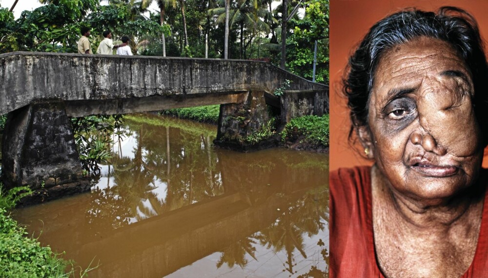 74 år gamle Lakshmi Kutty forteller at ifølge legene er svulsten hennes et resultat av et langt liv med fisk fra den forurensede floden, grønnsaker fra den giftige jorden og selvsagt har hun pustet inn forurenset luft og drukket giftig vann. 74 år gamle Lakshmi Kutty forteller at ifølge legene er svulsten hennes et resultat av et langt liv med fisk fra den forurensede floden, grønnsaker fra den giftige jorden og selvsagt har hun pustet inn forurenset luft og drukket giftig vann.