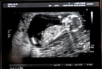 Gravid 17 uker Gravid 17 uker