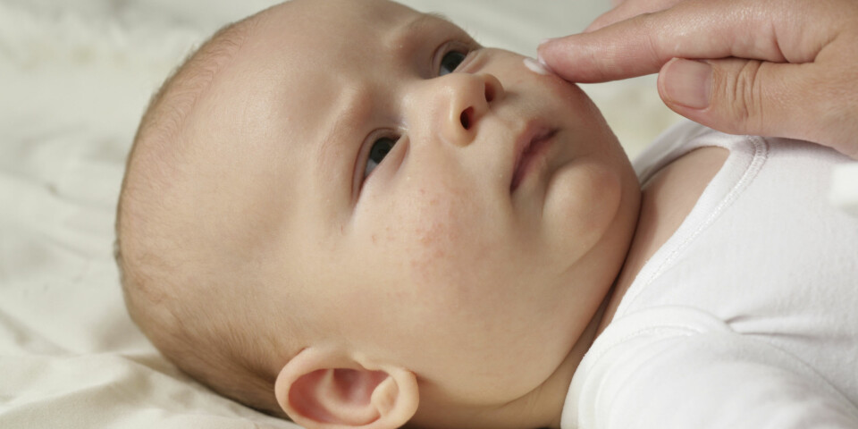 TØRR HUD HOS BABY: Sliter babyen din med tørr hud eller tørre flekker på huden? Tørr hud assosieres særlig med atopisk eksem. Foto: Gettyimages.com.