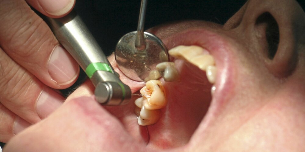 BETENNELER: Kan gi kronisk dårlig ånde - med mindre du tar tak i situasjonen og kommer deg til tannlegen for behandling.