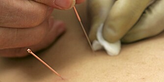 ALTERNATIV: Homeopater og akupunktører mener de har hjelp mot blærekatarr.